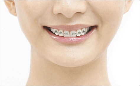 矯正歯科イメージ写真