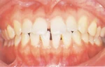すき歯（空隙歯列弓）