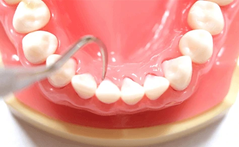 歯石除去イメージ